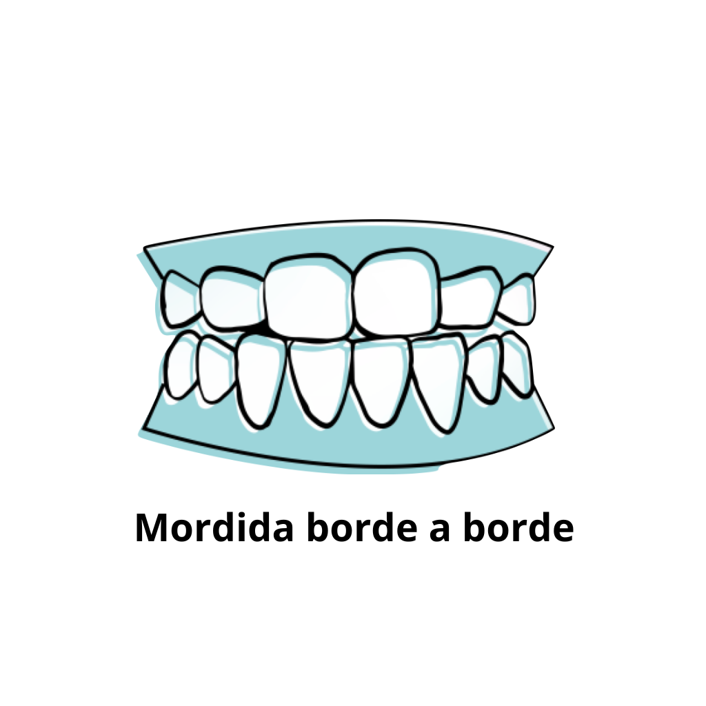 Mordida borde a borde en Clínica de Ortodoncia en Teatinos Málaga