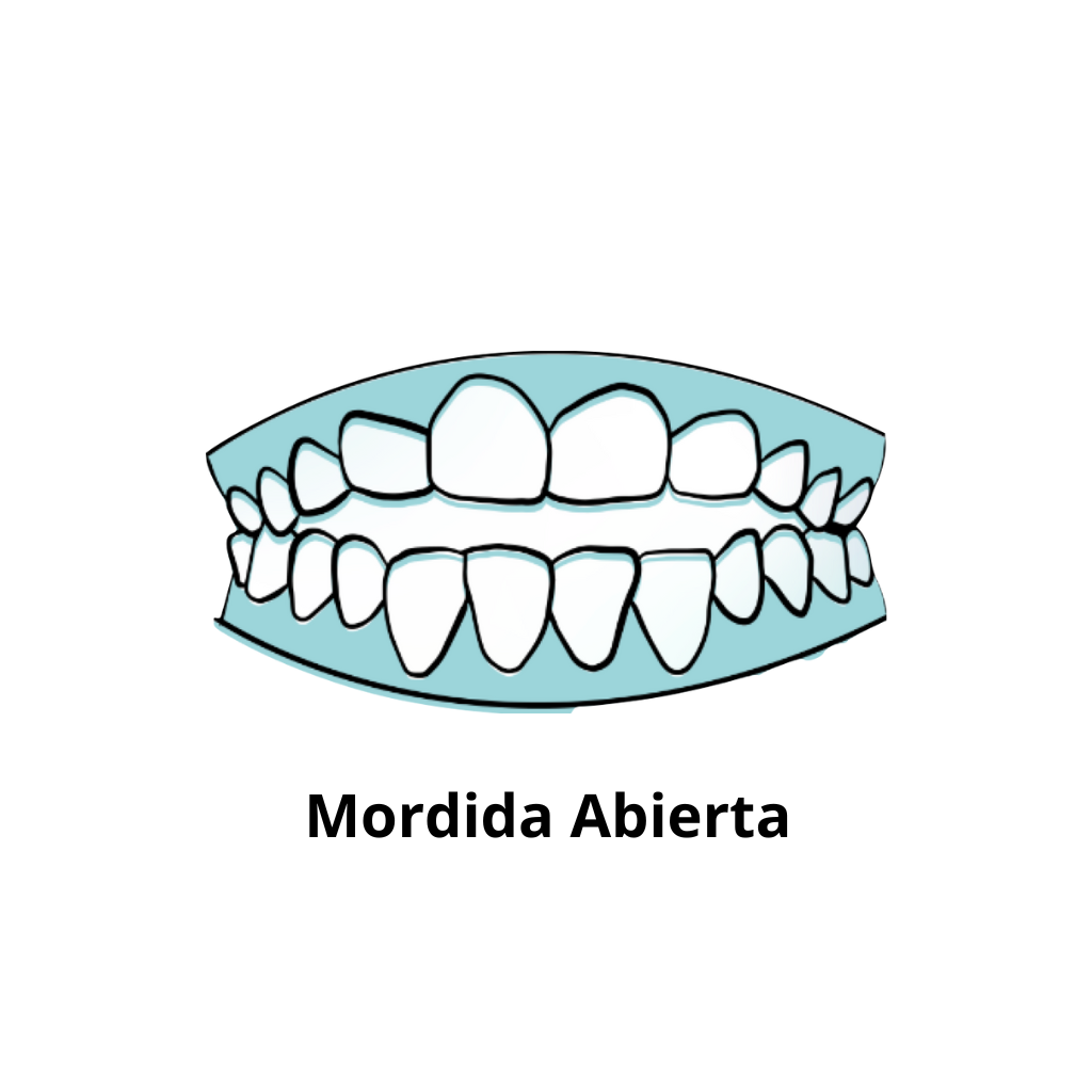 Mordida abierta tratada en Ortodoncia Teatinos en Málaga
